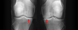 Ost Otomie Tibiale De Valgisation Chirurgie Du Genou Paris